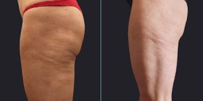 I-Laser Before & After Gallery - Patient 168325 - Image 1