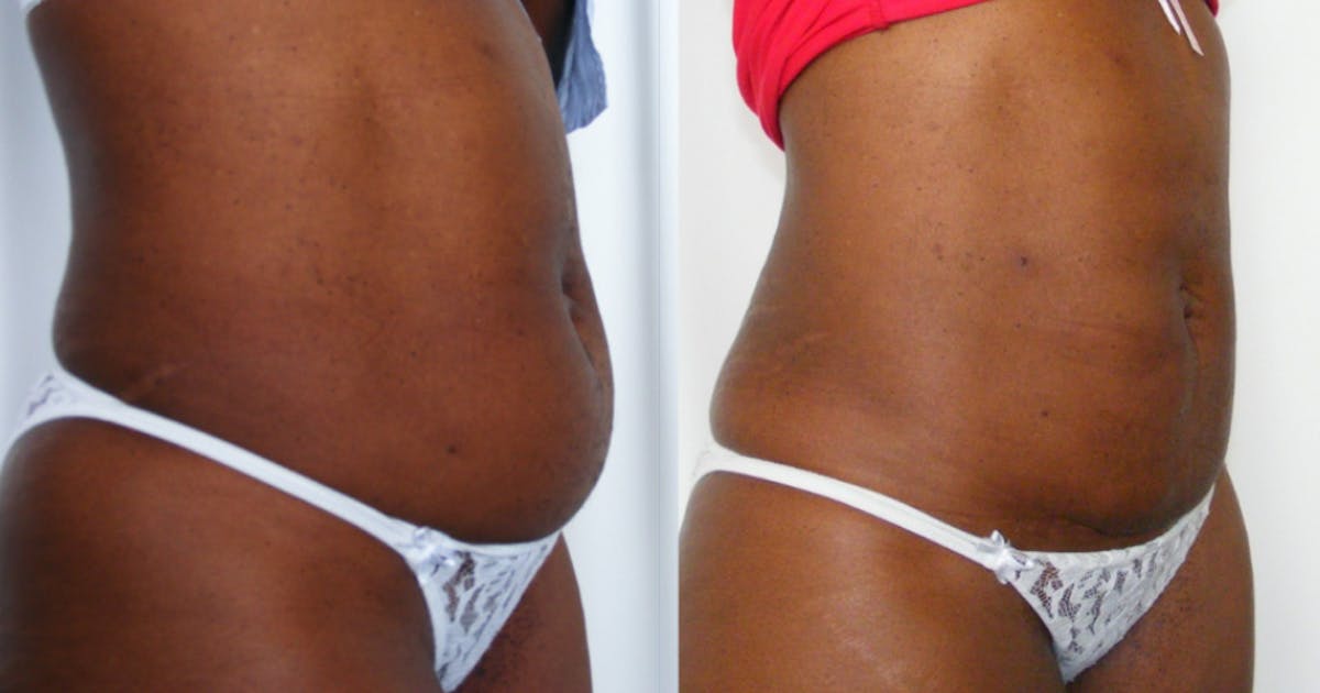 I-Laser Before & After Gallery - Patient 390114 - Image 1