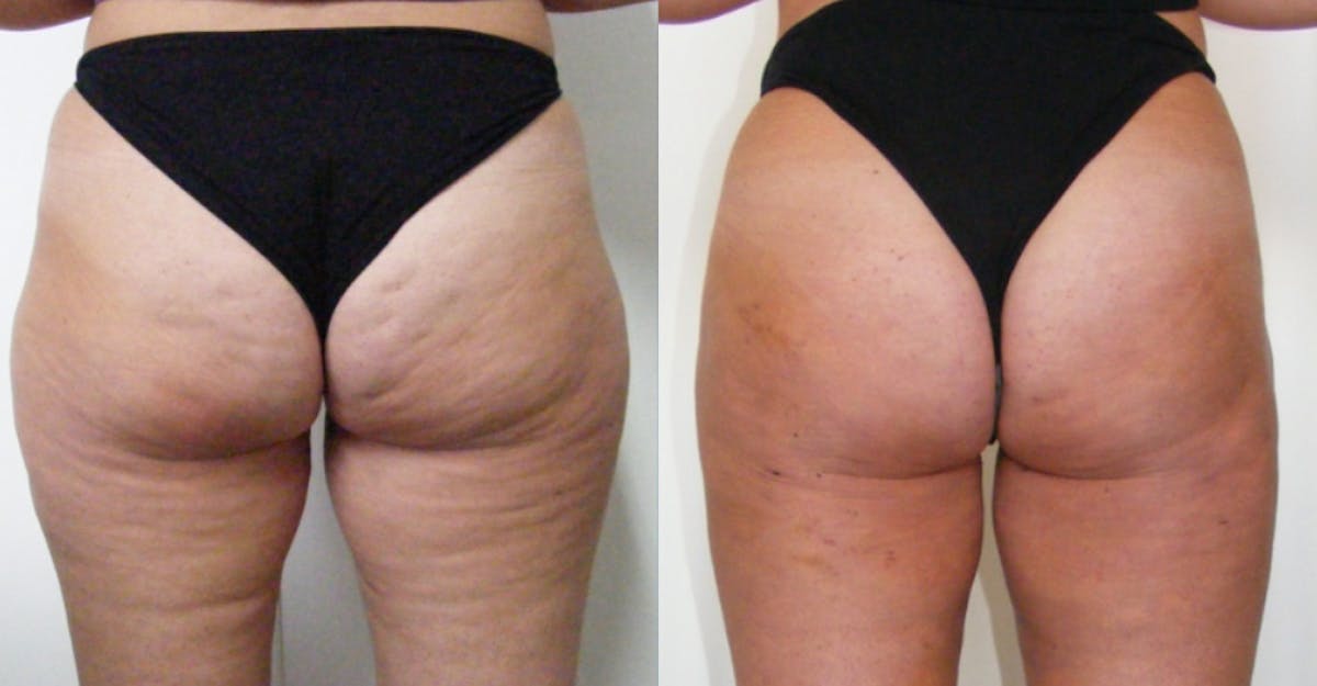 I-Laser Before & After Gallery - Patient 418866 - Image 1