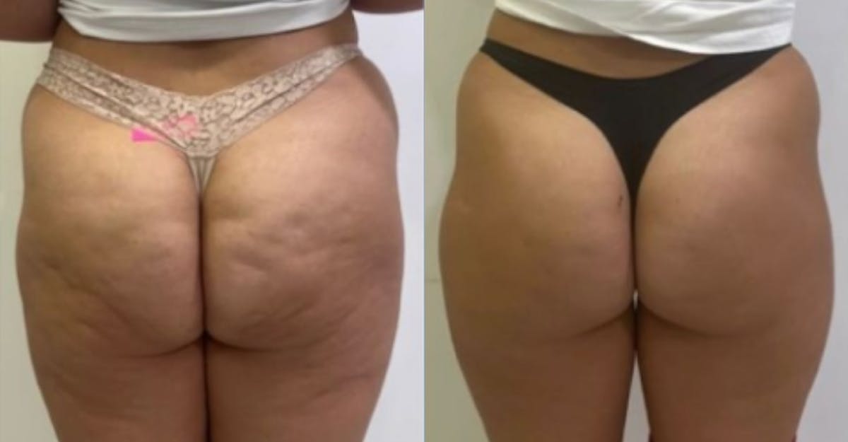 I-Laser Before & After Gallery - Patient 432980 - Image 1