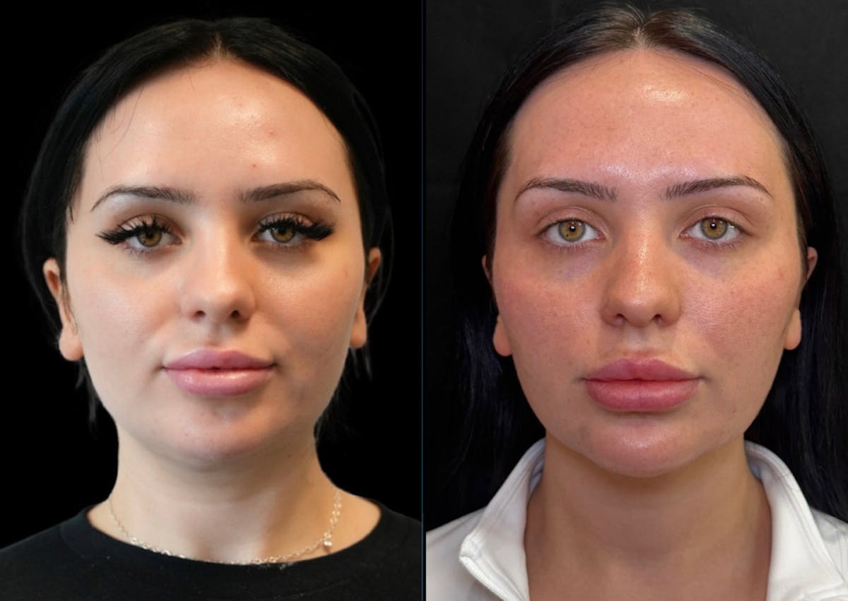 I-Laser Before & After Gallery - Patient 334360 - Image 1