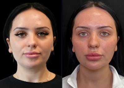 I-Laser Before & After Gallery - Patient 334360 - Image 1
