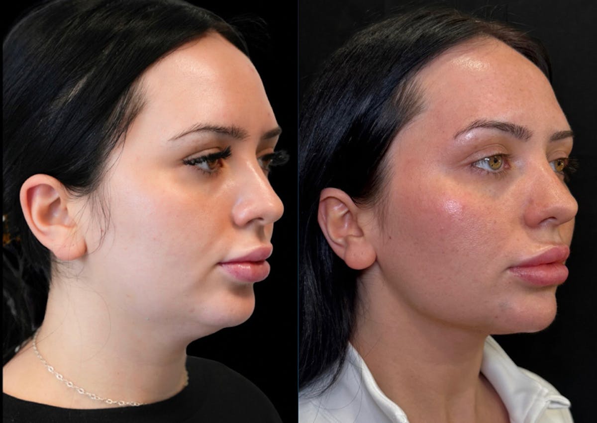 I-Laser Before & After Gallery - Patient 334360 - Image 2
