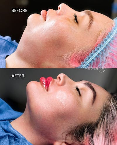I-Laser Before & After Gallery - Patient 140873 - Image 1