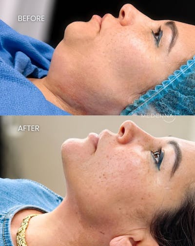I-Laser Before & After Gallery - Patient 353634 - Image 1