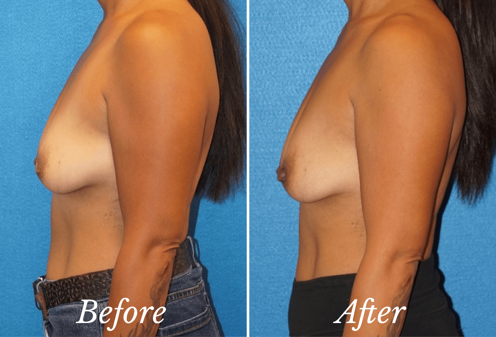 Inverted Nipple Repair (old) Before & After Gallery - Patient 318714 - Image 1