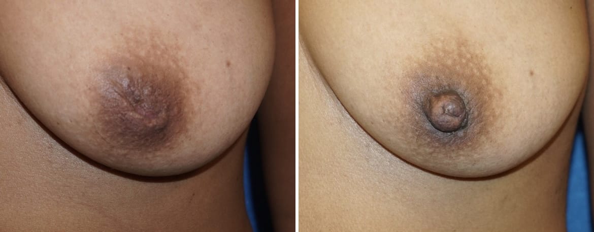 Inverted Nipple Repair Before & After Gallery - Patient 102617 - Image 2