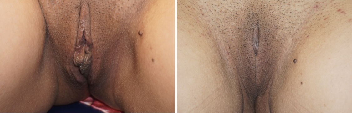 Labiaplasty Before & After Gallery - Patient 307877 - Image 1