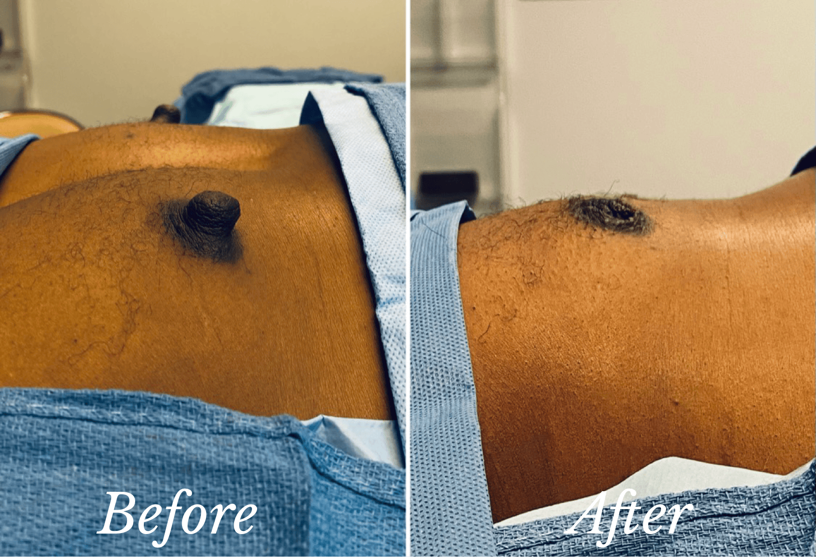 Nipple Reduction Before & After Gallery - Patient 346887 - Image 1