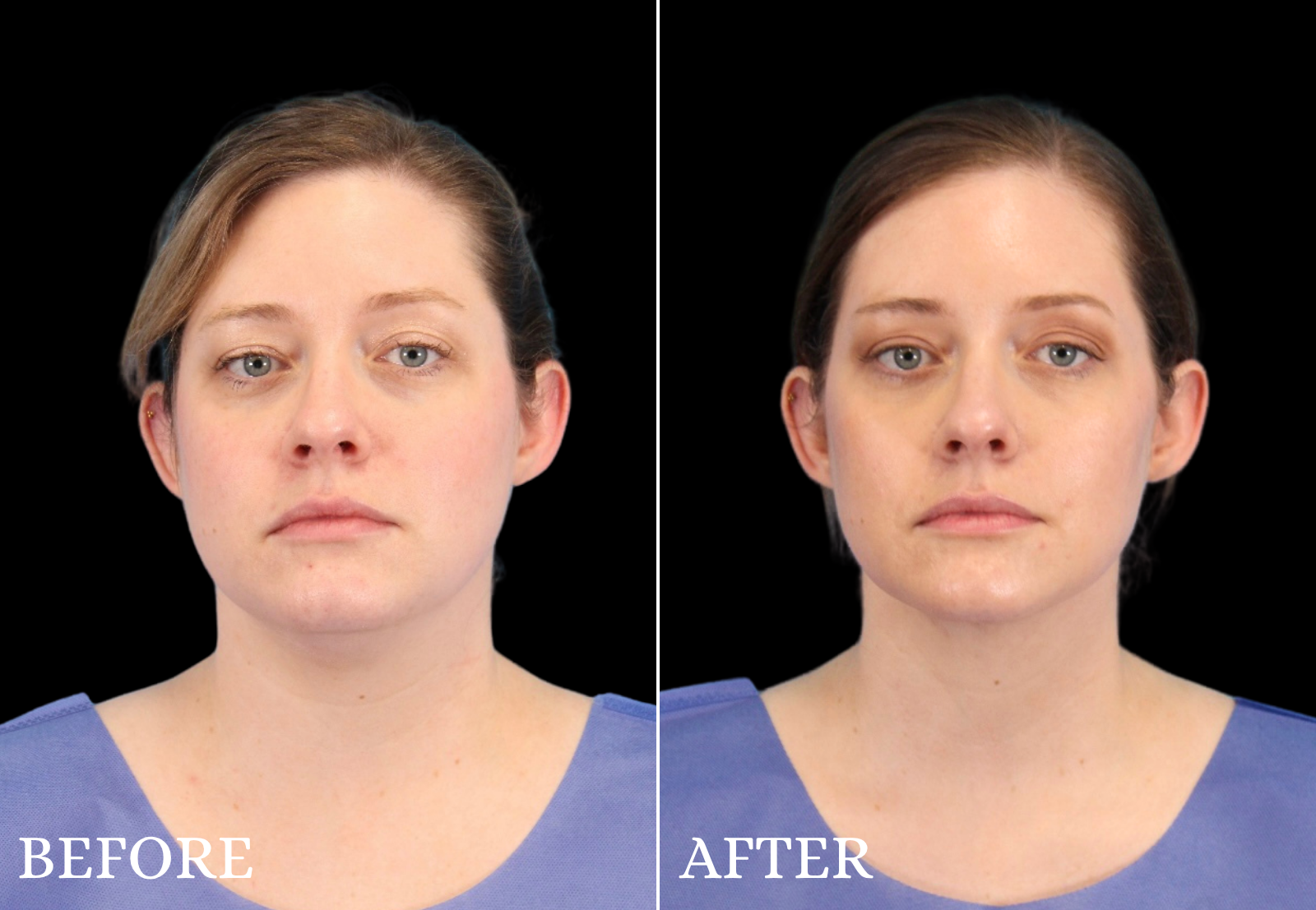 Chin Liposuction Before & After Gallery - Patient 325638 - Image 3