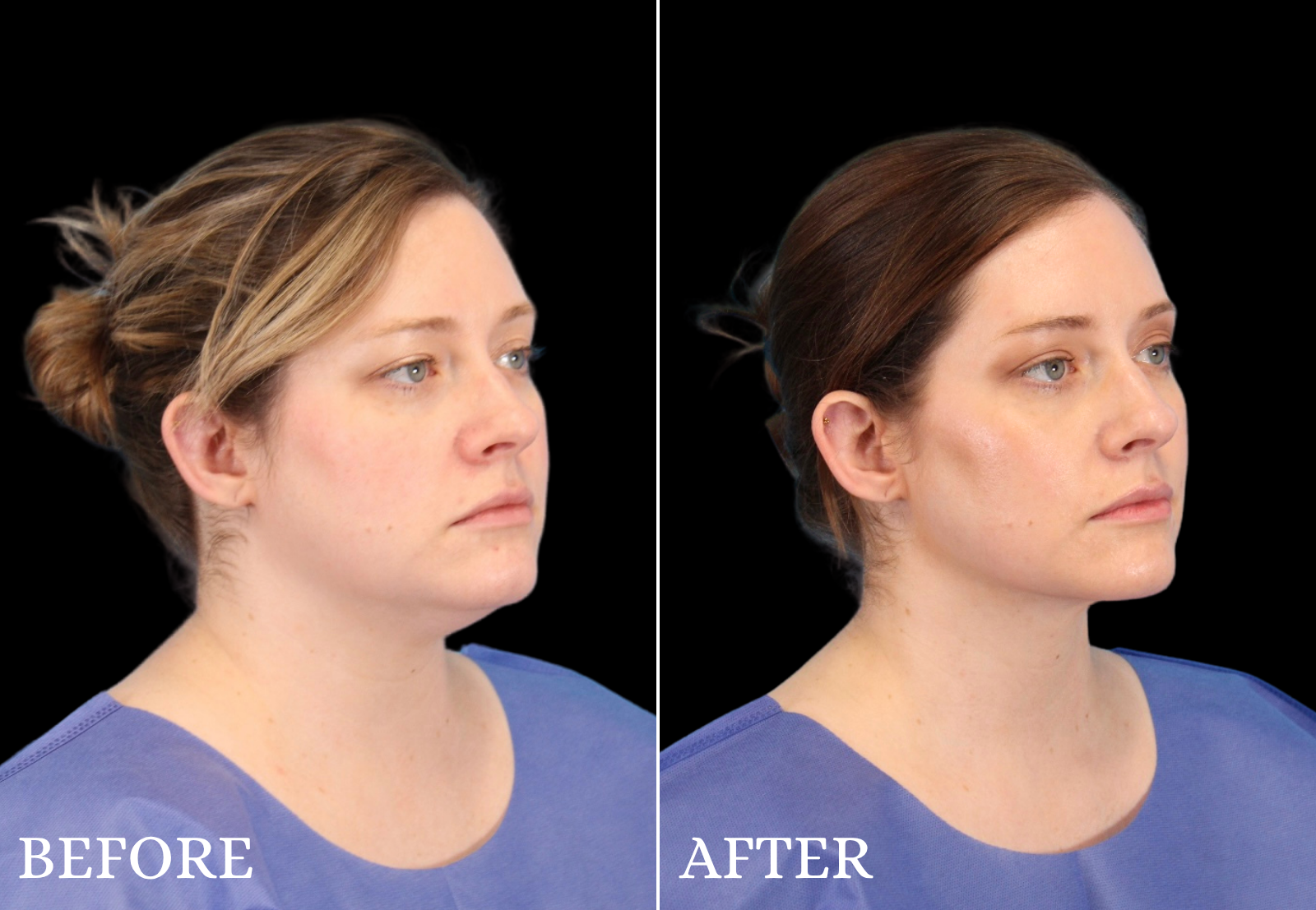 Chin Liposuction Before & After Gallery - Patient 325638 - Image 2