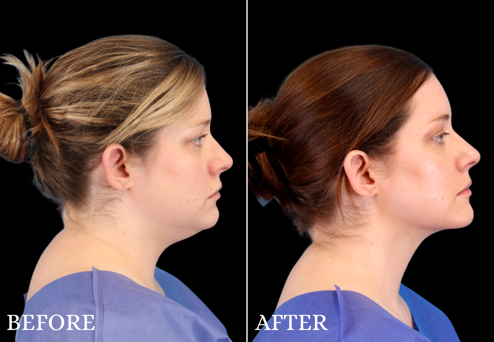 Chin Liposuction Before & After Gallery - Patient 325638 - Image 1