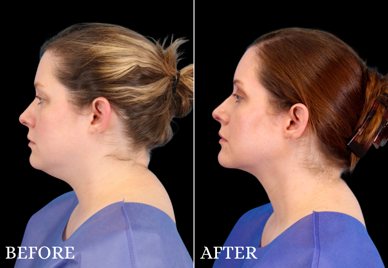 Chin Liposuction Before & After Gallery - Patient 325638 - Image 5