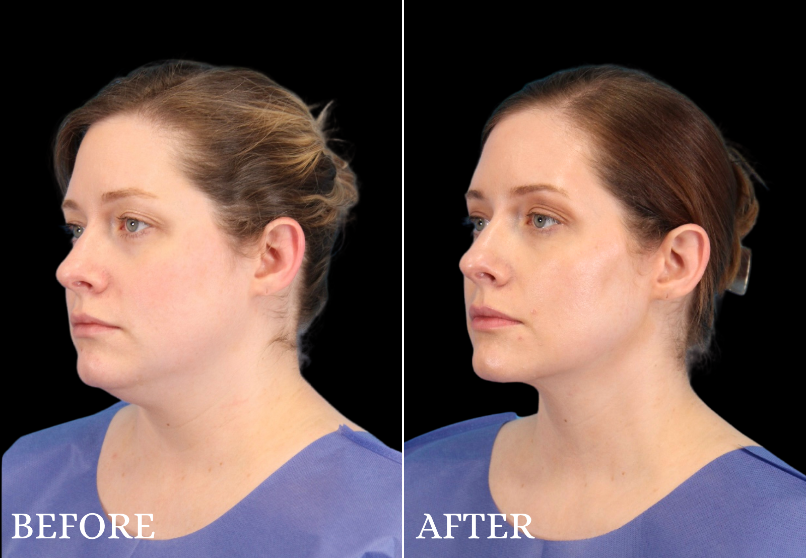 Chin Liposuction Before & After Gallery - Patient 325638 - Image 4