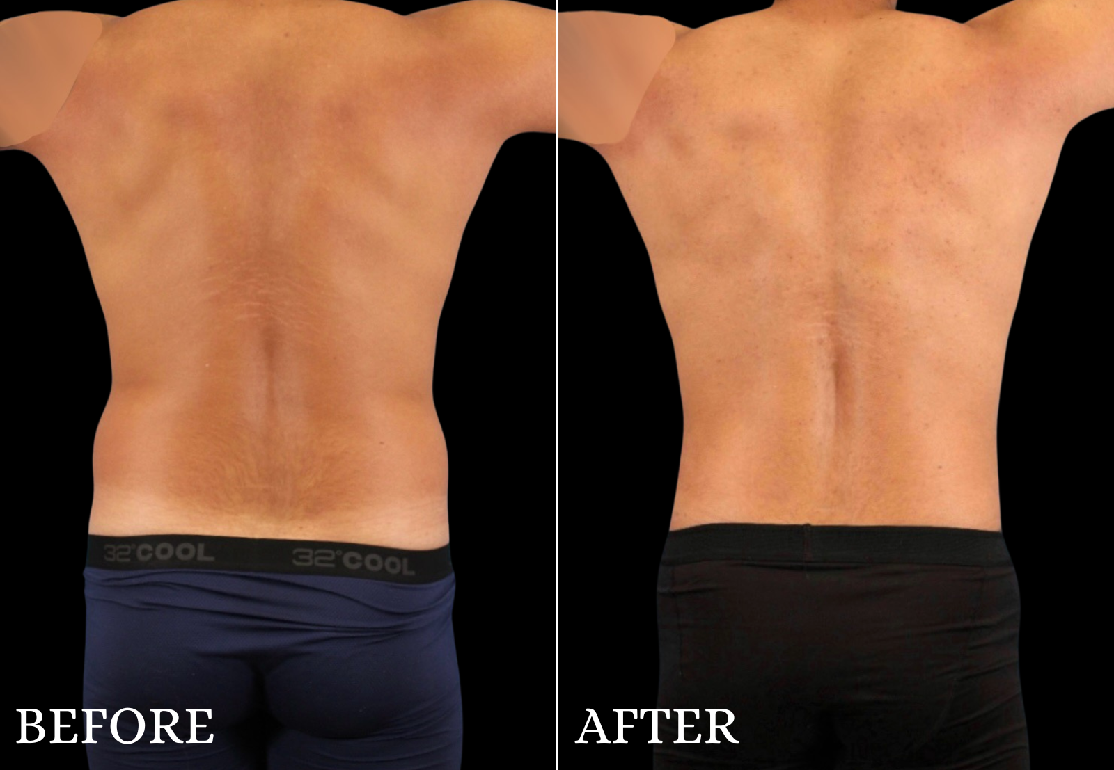 Liposuction Before & After Gallery - Patient 312824 - Image 2