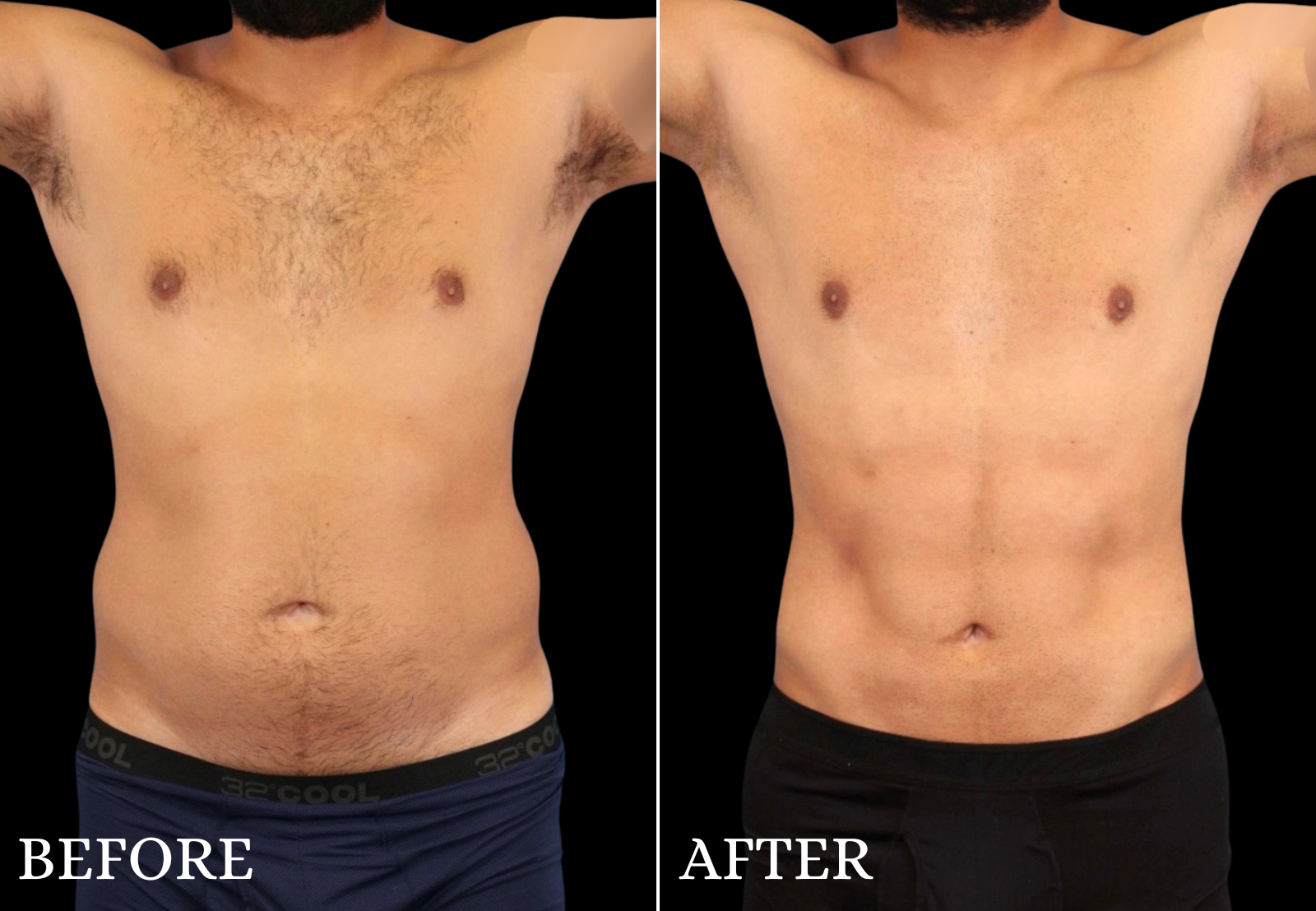 Liposuction Before & After Gallery - Patient 312824 - Image 1