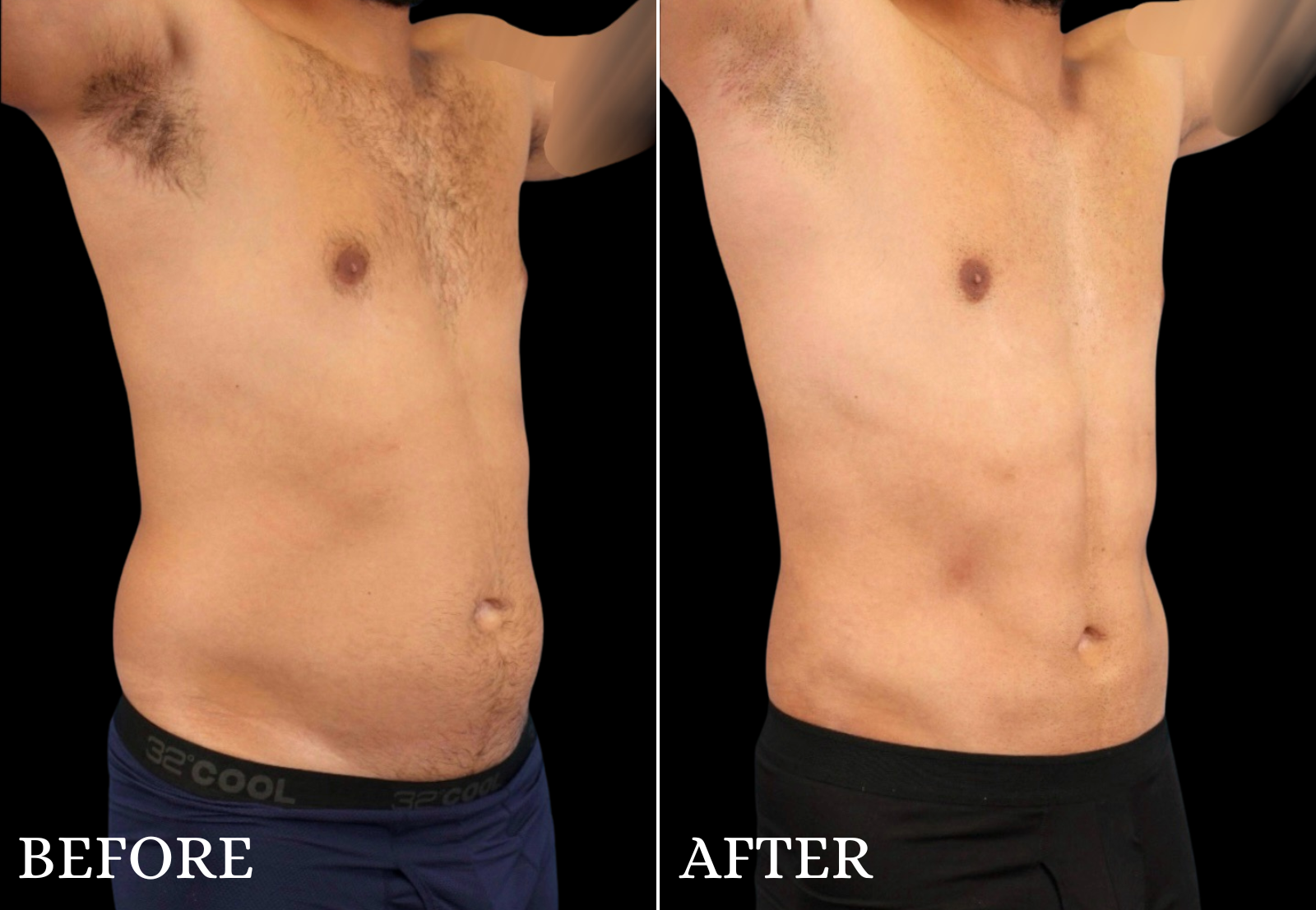 Liposuction Before & After Gallery - Patient 312824 - Image 3