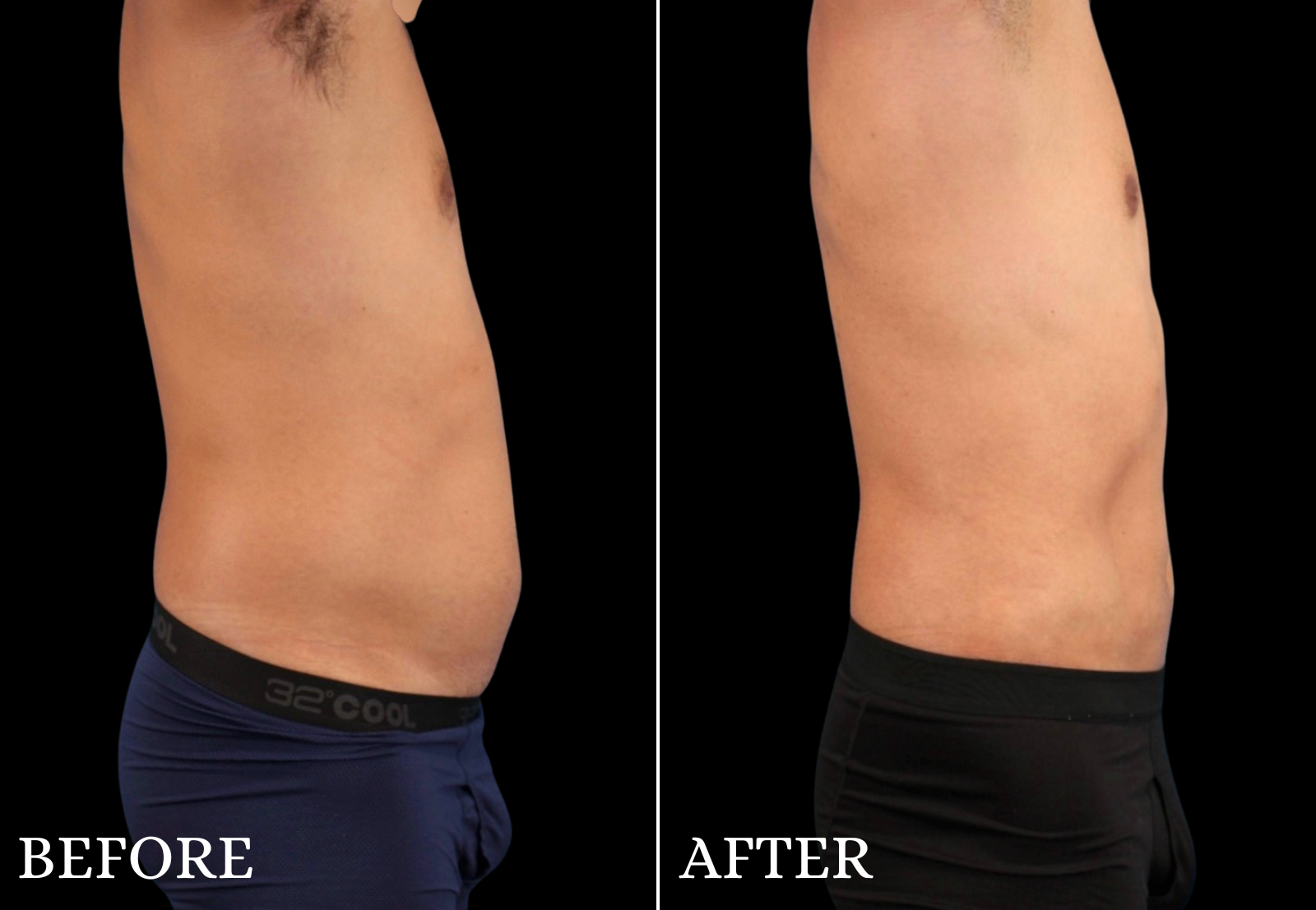 Liposuction Before & After Gallery - Patient 312824 - Image 4