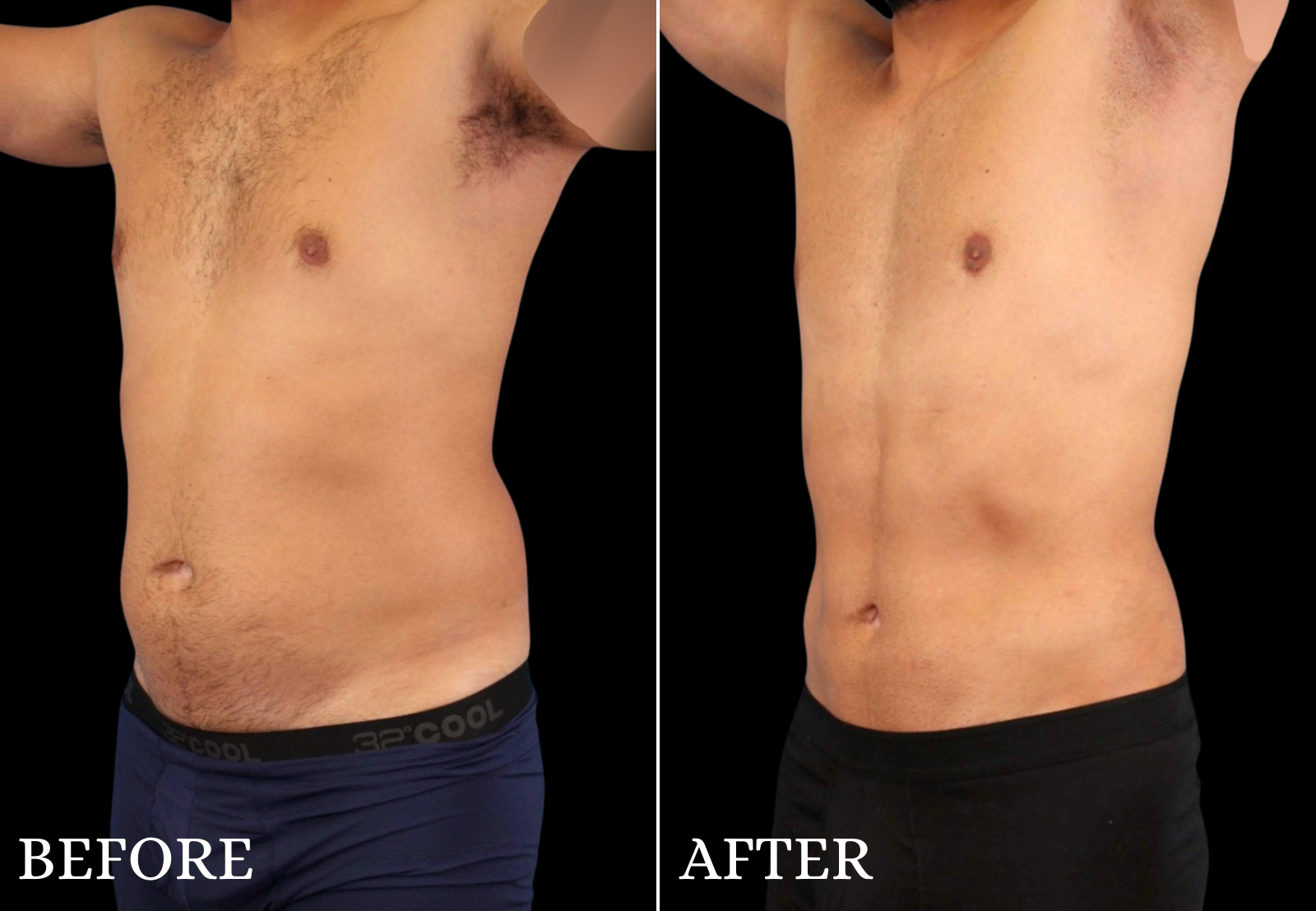 Liposuction Before & After Gallery - Patient 312824 - Image 5