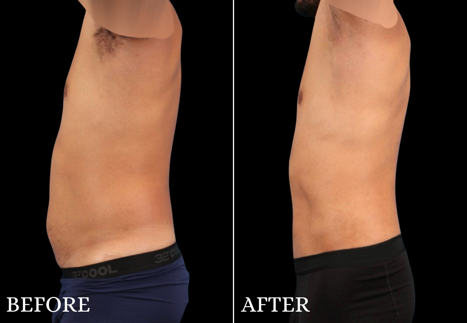 Liposuction Before & After Gallery - Patient 312824 - Image 6