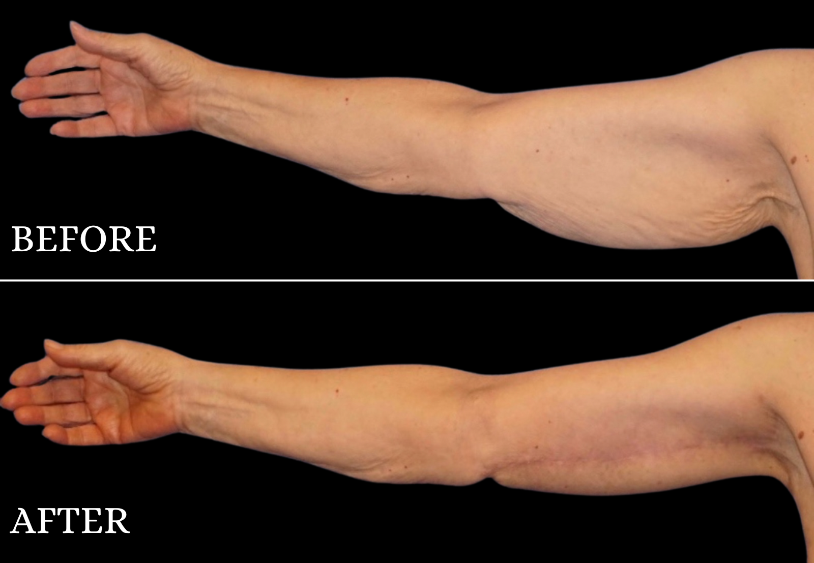 Arm Lift Before & After Gallery - Patient 133188 - Image 1