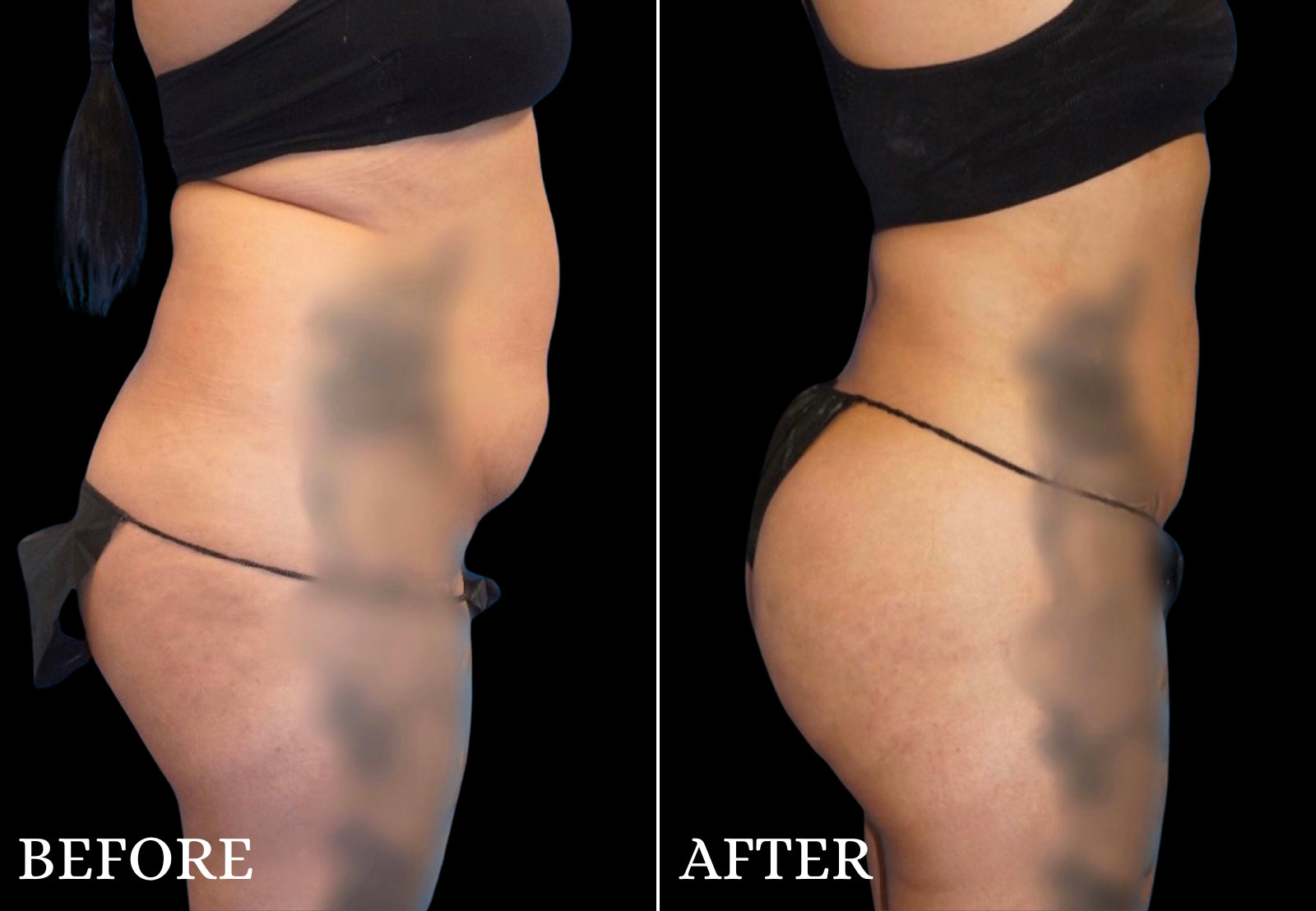 Brazilian Butt Lift Before & After Gallery - Patient 296245 - Image 5