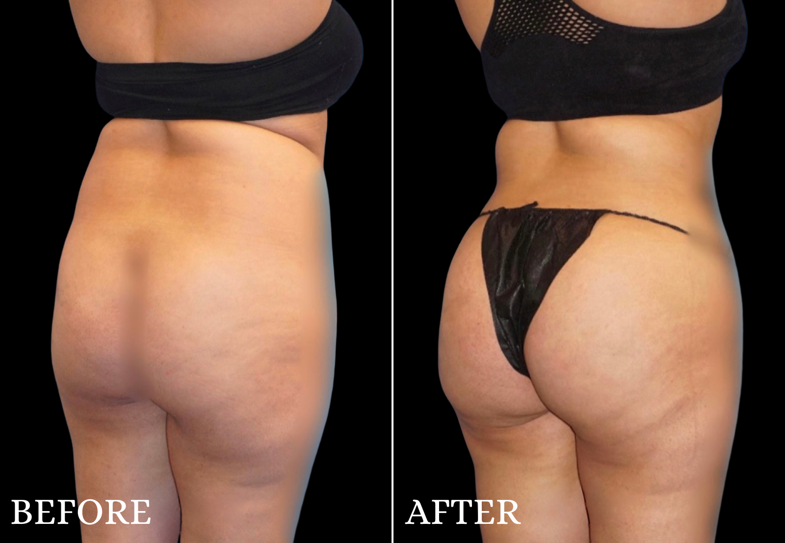 Brazilian Butt Lift Before & After Gallery - Patient 296245 - Image 1