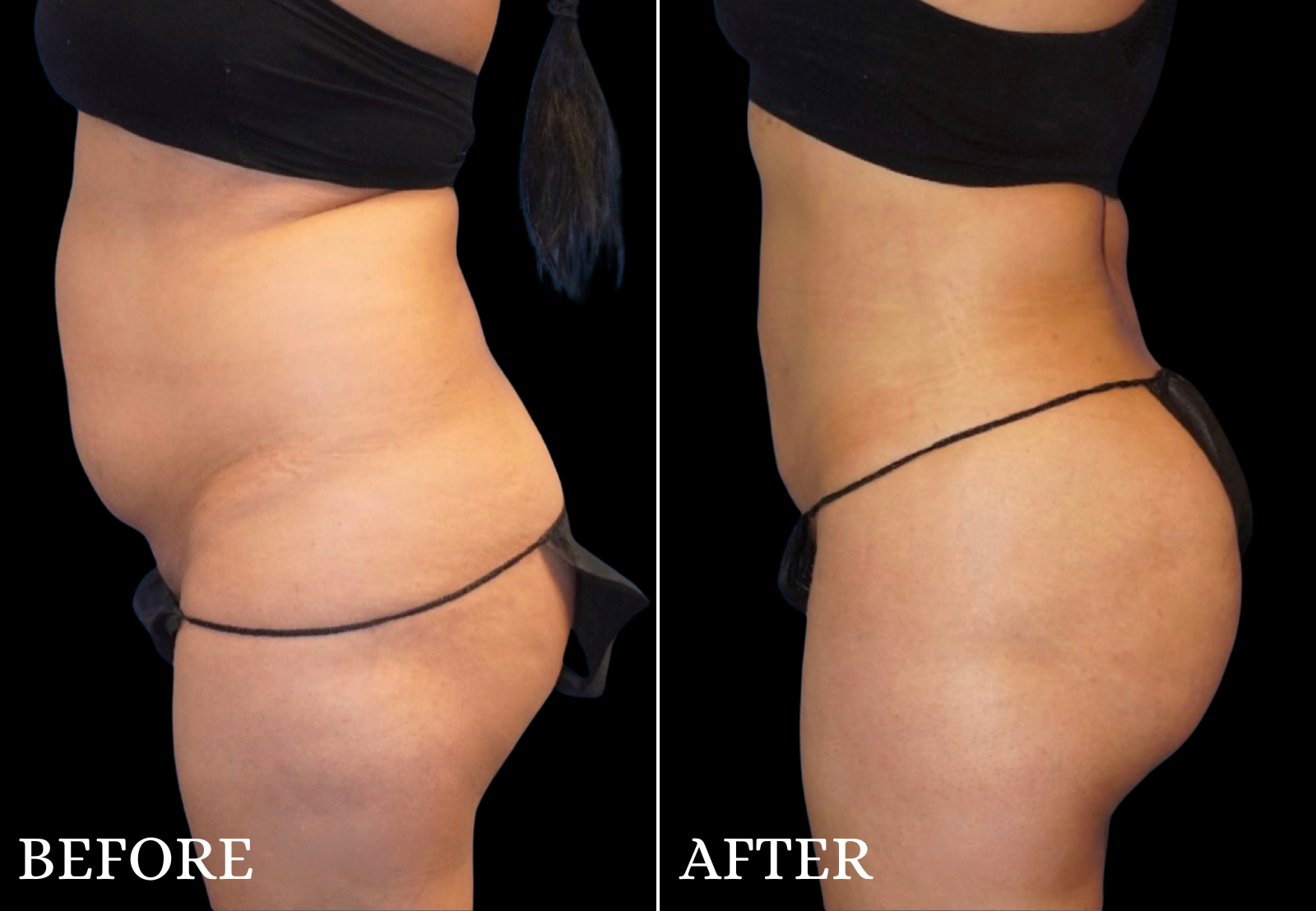 Brazilian Butt Lift Before & After Gallery - Patient 296245 - Image 3