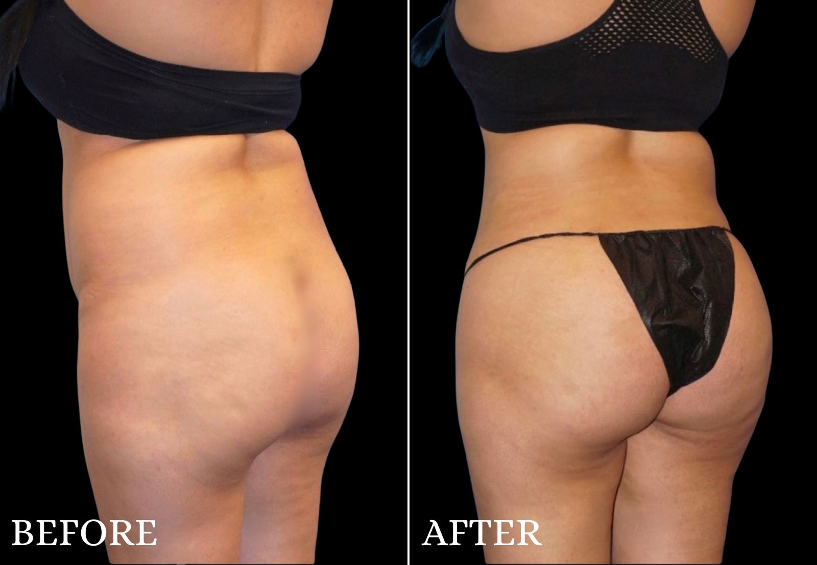 Brazilian Butt Lift Before & After Gallery - Patient 296245 - Image 2