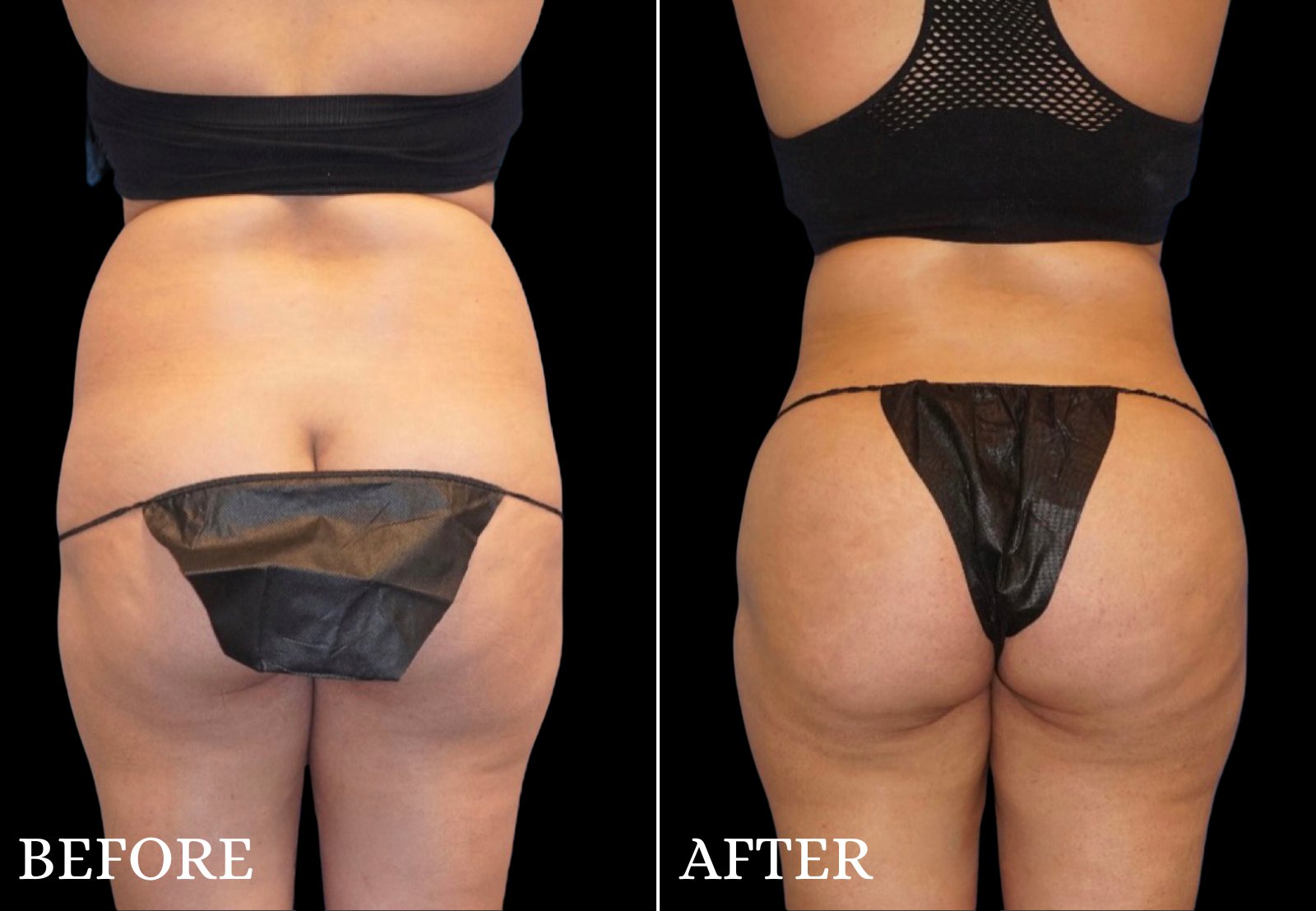 Brazilian Butt Lift Before & After Gallery - Patient 296245 - Image 4