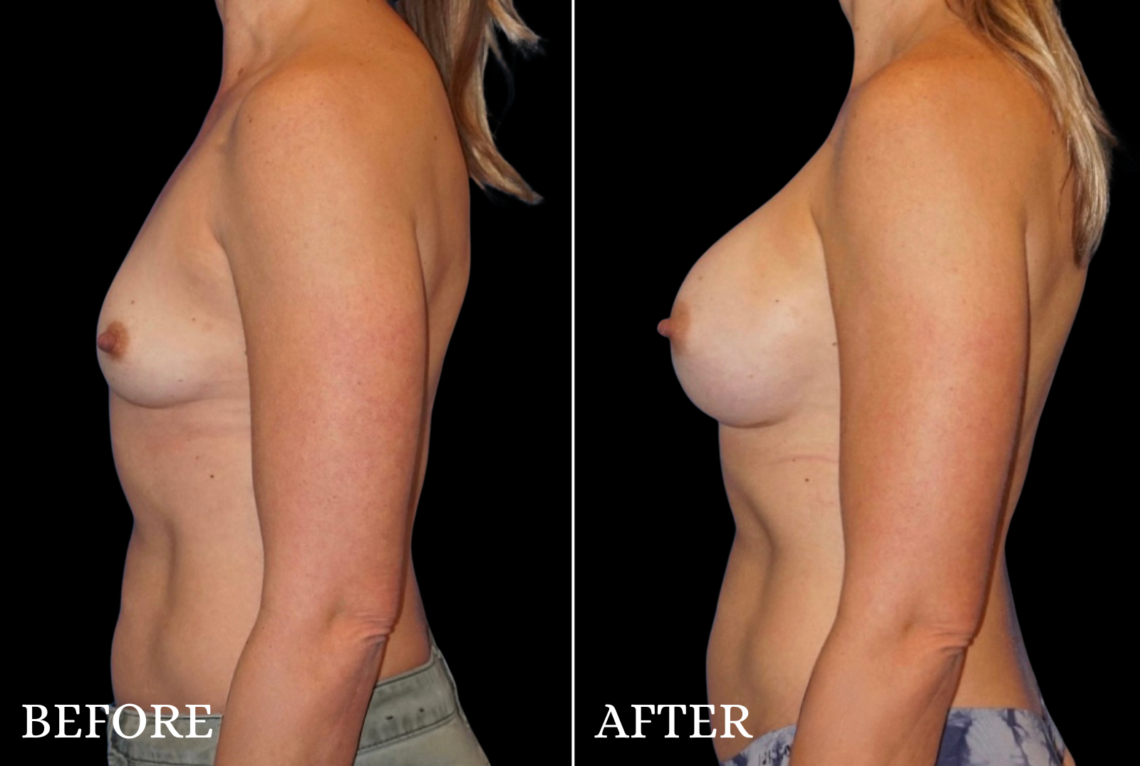 Breast Augmentation Before & After Gallery - Patient 107837 - Image 5