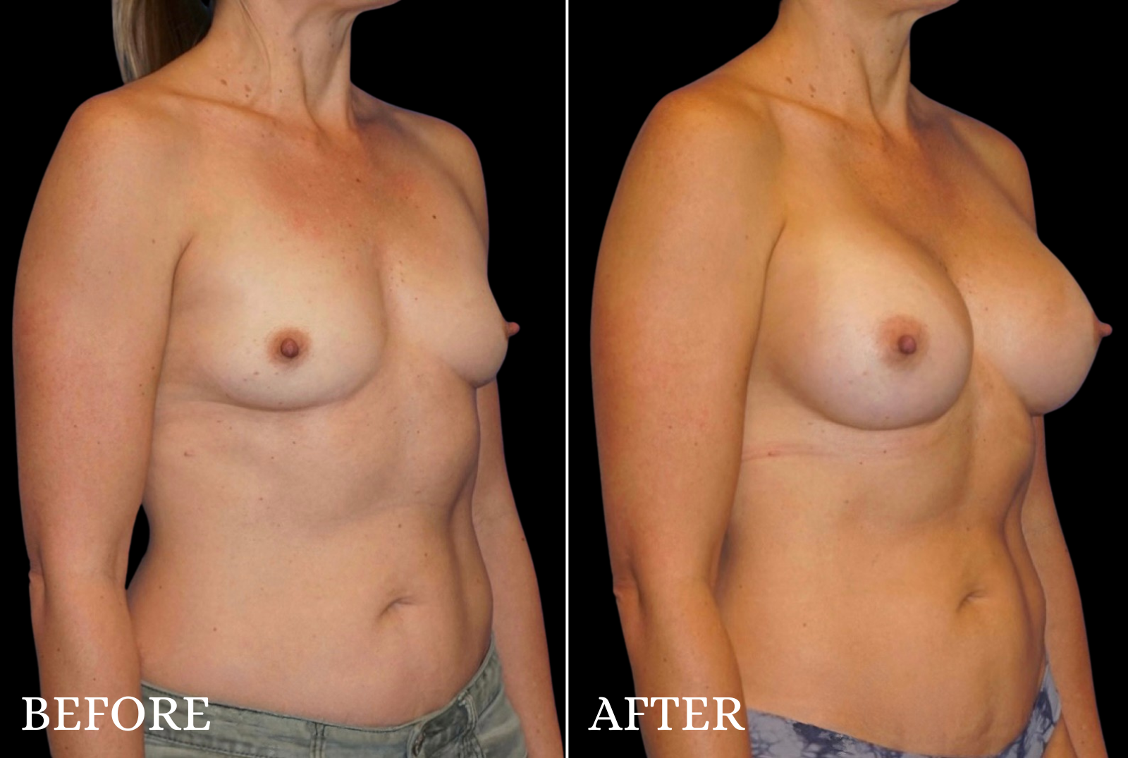 Breast Augmentation Before & After Gallery - Patient 107837 - Image 2