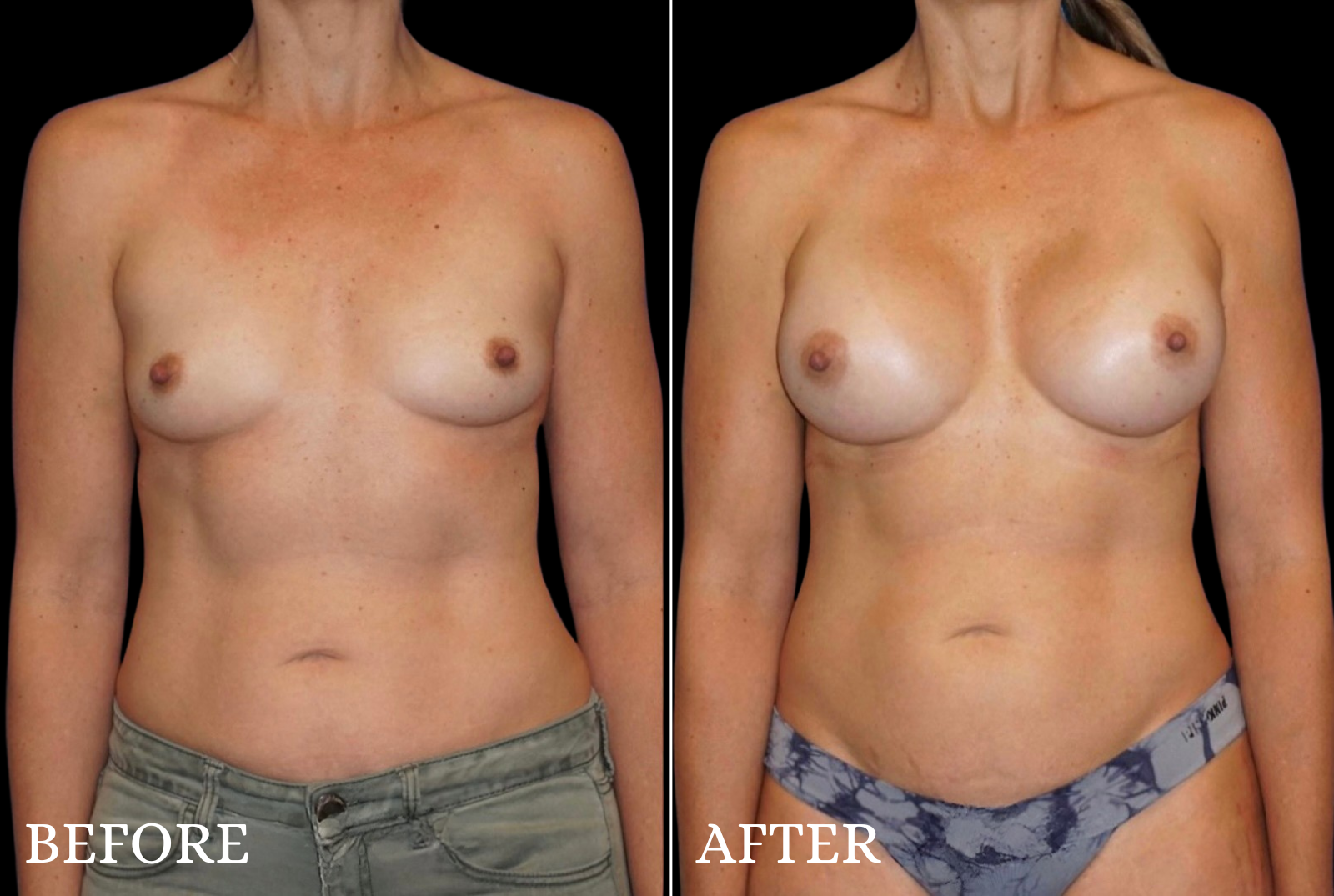 Breast Augmentation Before & After Gallery - Patient 107837 - Image 1