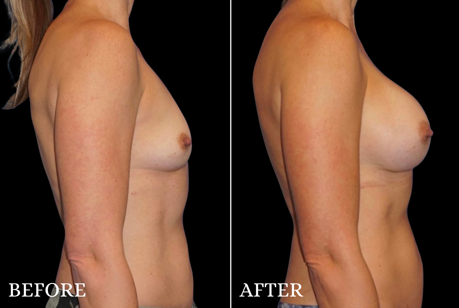 Breast Augmentation Before & After Gallery - Patient 107837 - Image 3
