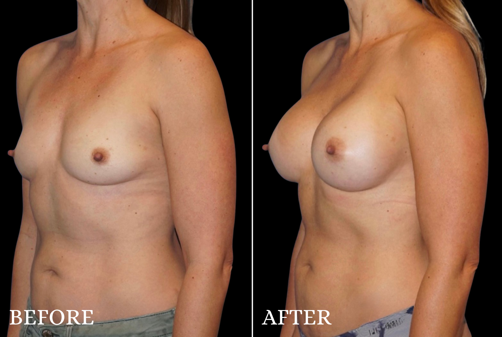 Breast Augmentation Before & After Gallery - Patient 107837 - Image 4