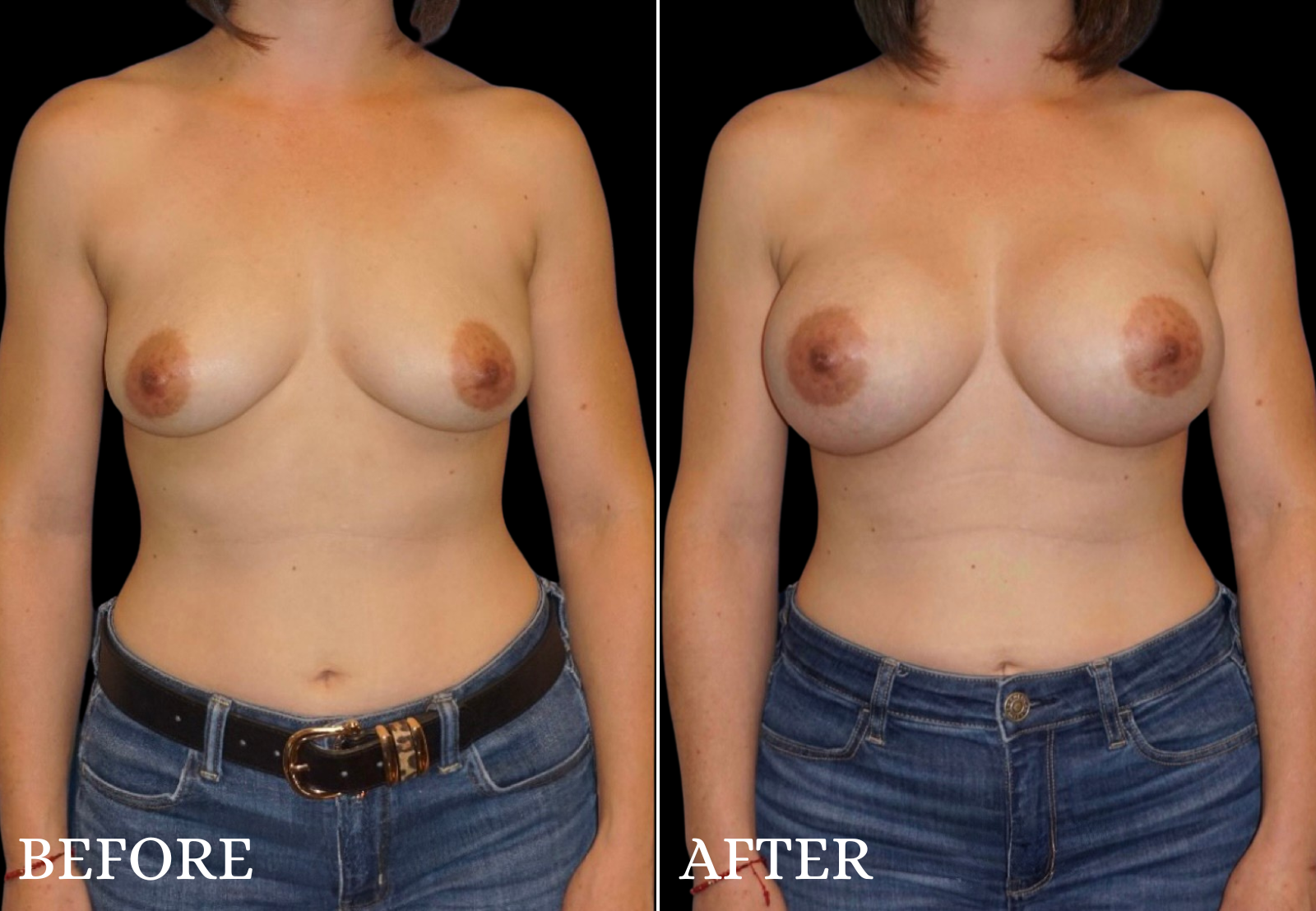 Breast Augmentation Before & After Gallery - Patient 362259 - Image 1