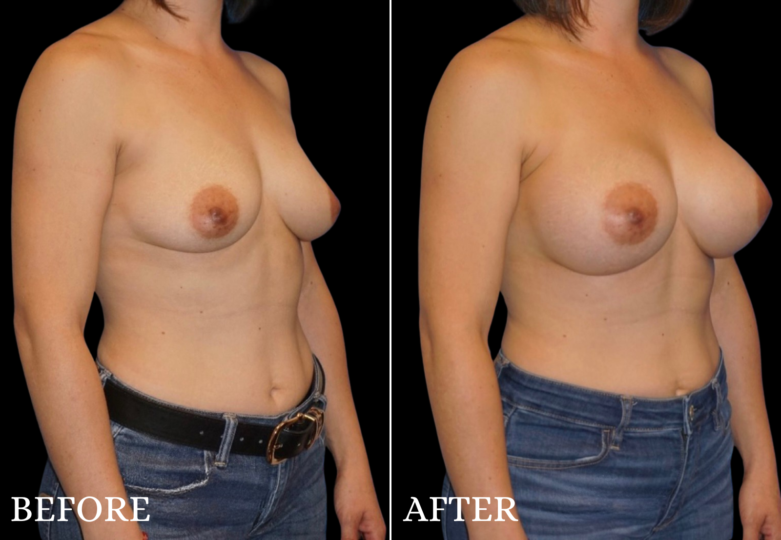 Breast Augmentation Before & After Gallery - Patient 362259 - Image 2