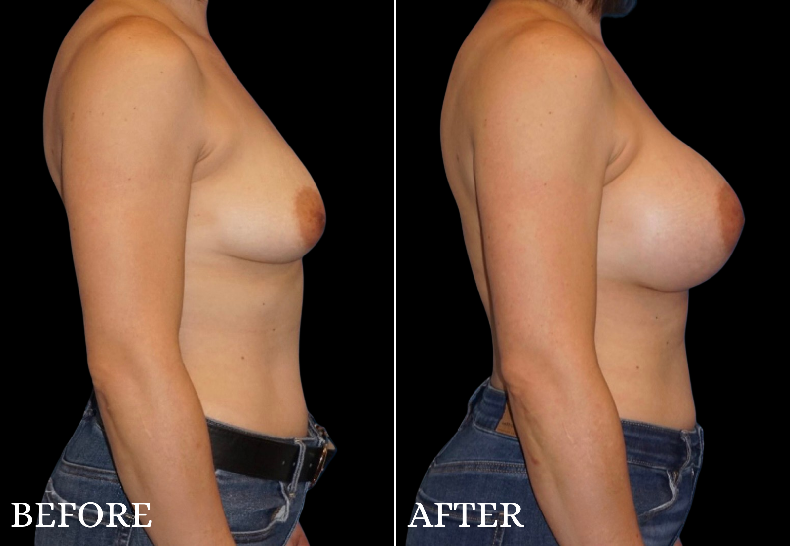 Breast Augmentation Before & After Gallery - Patient 362259 - Image 3