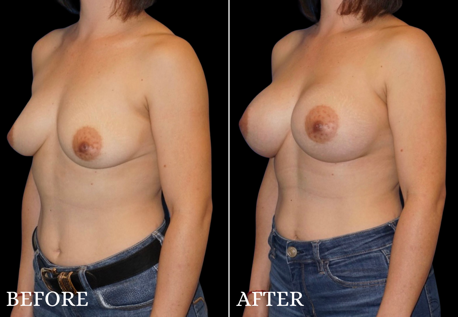 Breast Augmentation Before & After Gallery - Patient 362259 - Image 4