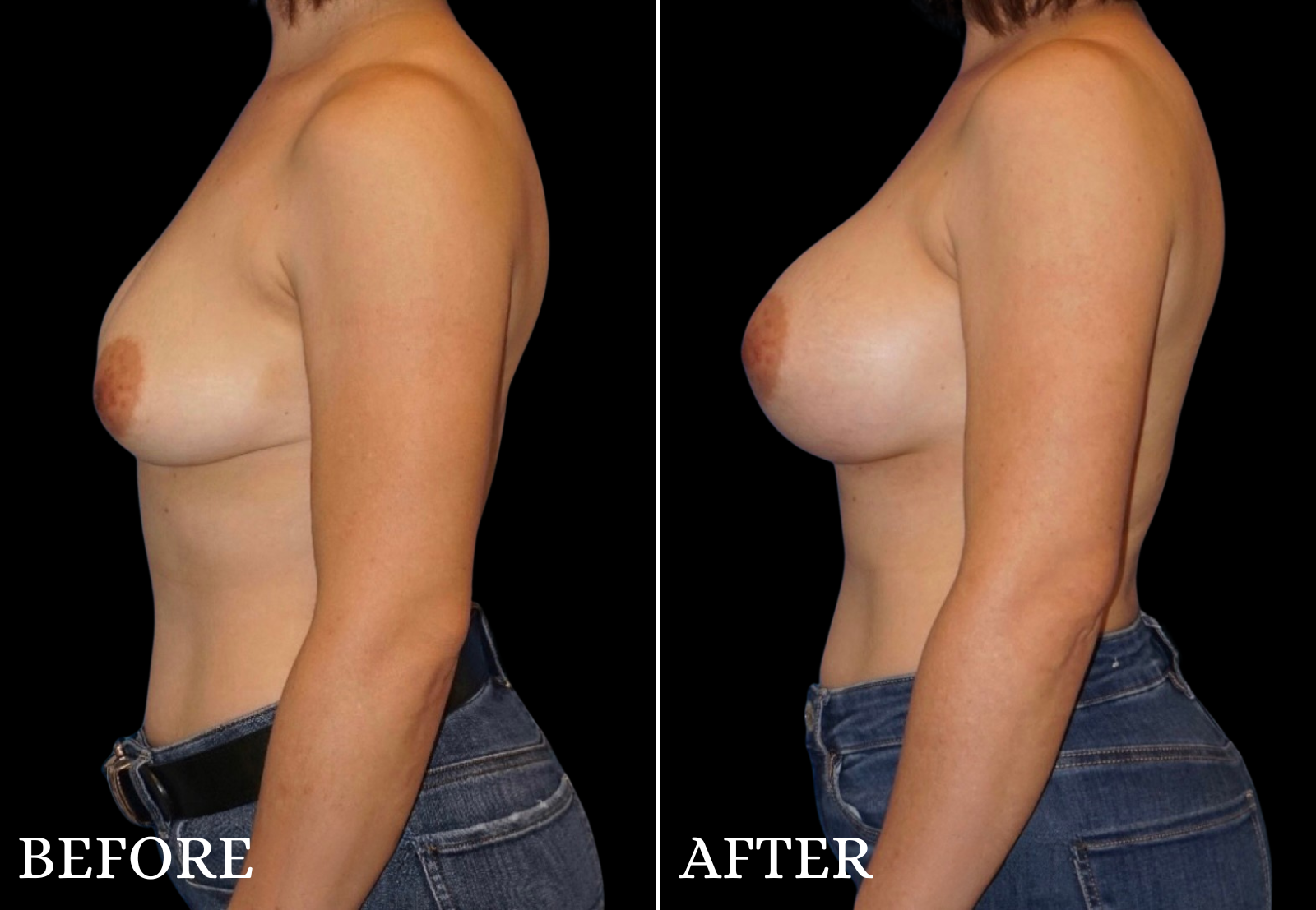 Breast Augmentation Before & After Gallery - Patient 362259 - Image 5