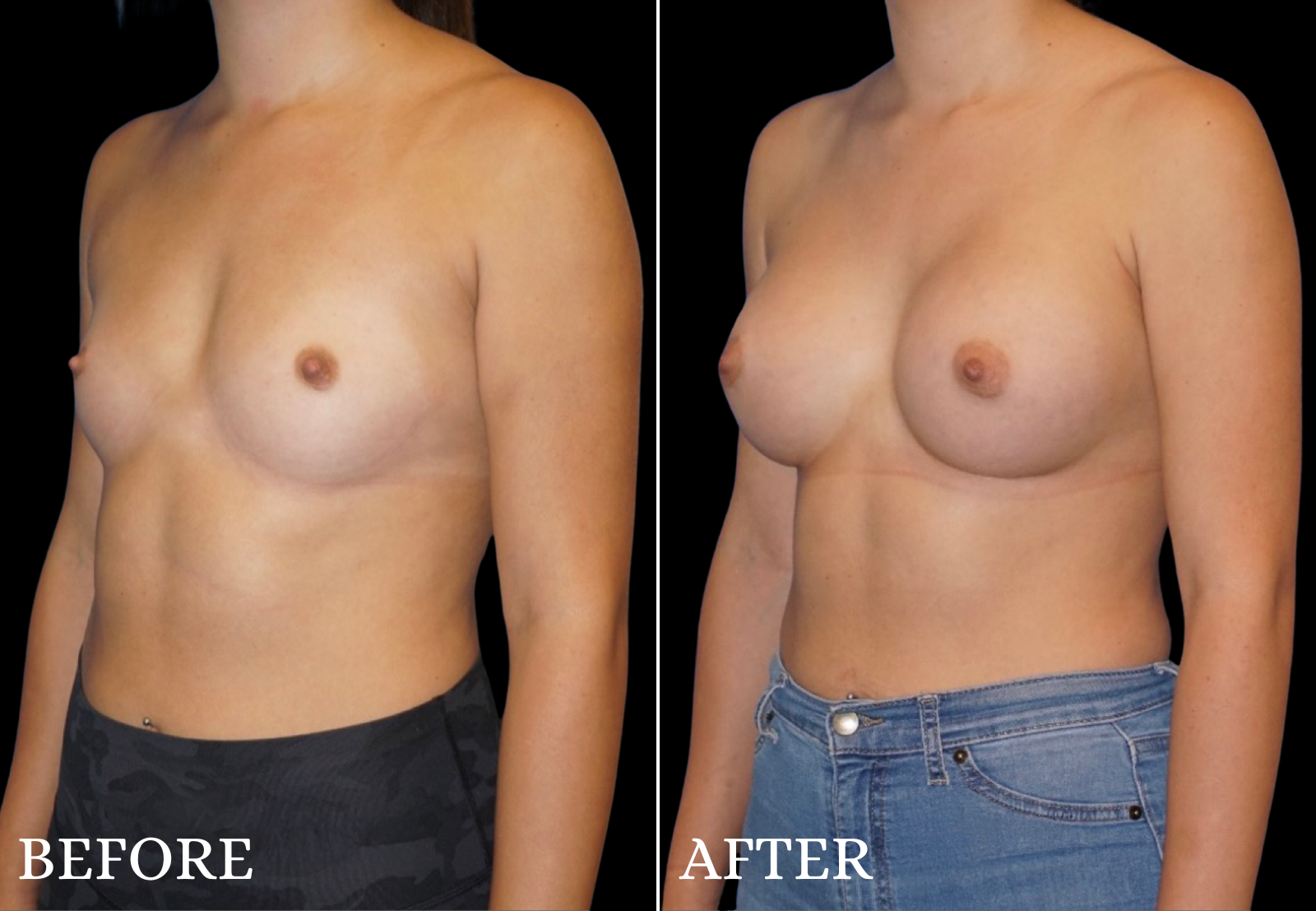 Breast Augmentation Before & After Gallery - Patient 265397 - Image 1