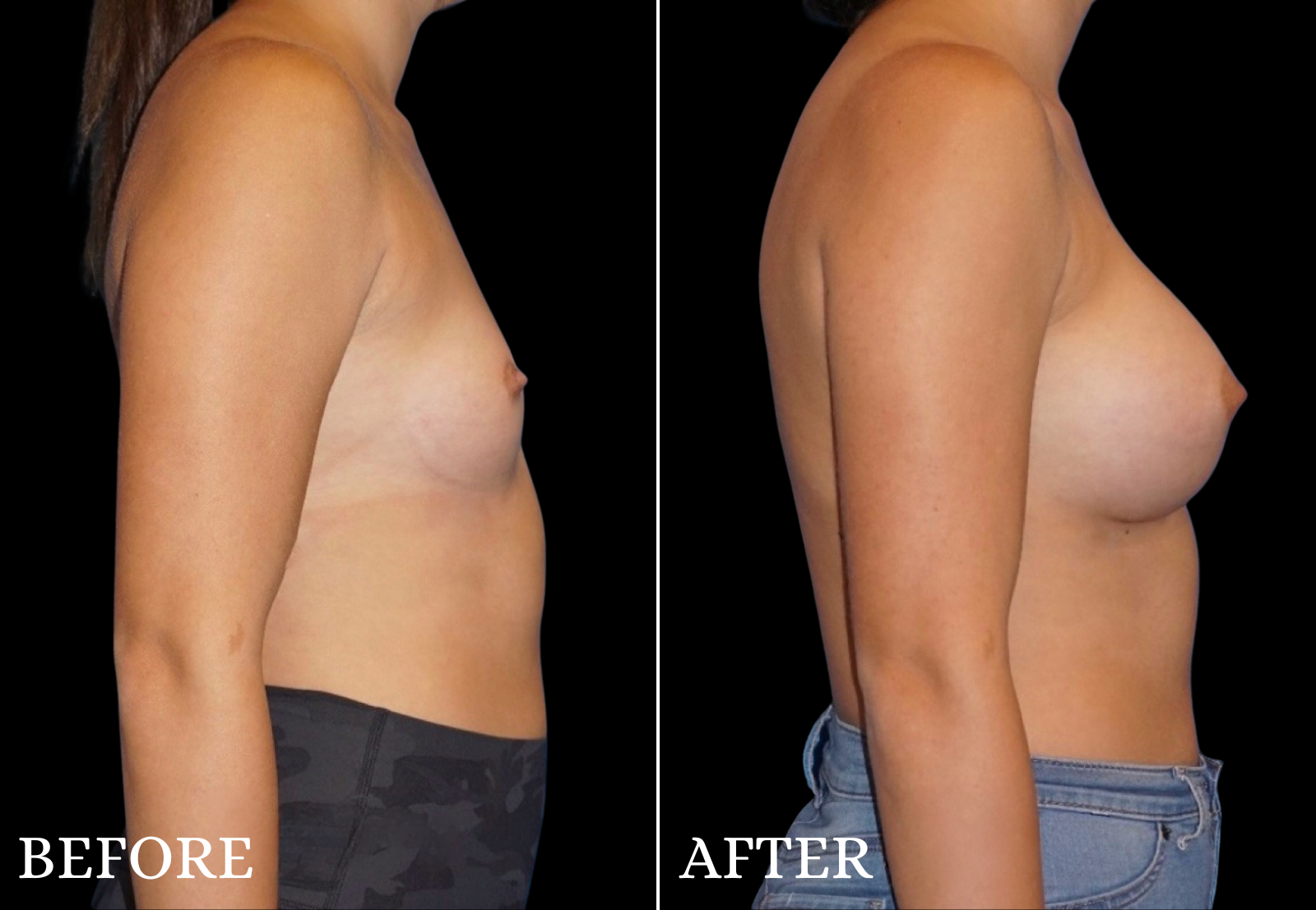 Breast Augmentation Before & After Gallery - Patient 265397 - Image 2