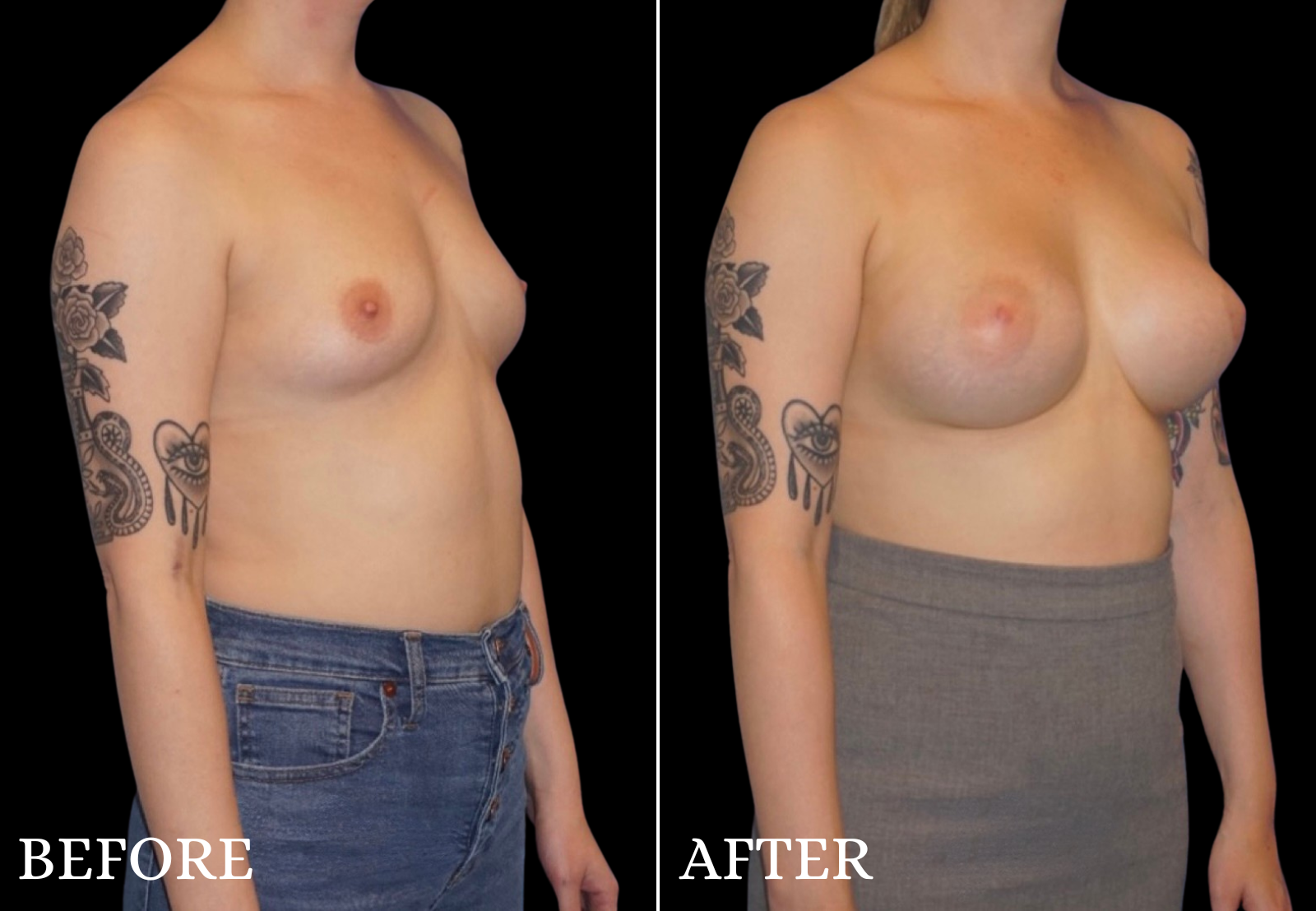 Breast Augmentation Before & After Gallery - Patient 109562 - Image 2