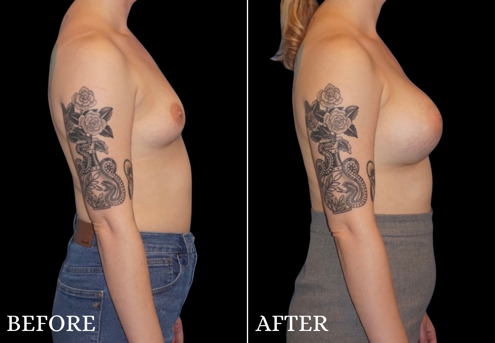 Breast Augmentation Before & After Gallery - Patient 109562 - Image 3