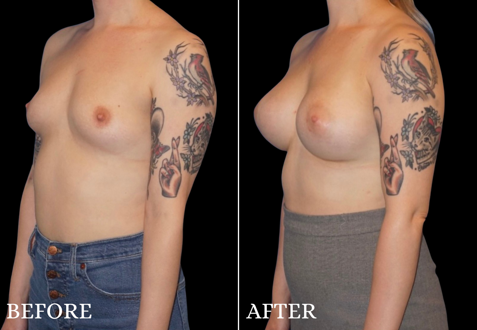 Breast Augmentation Before & After Gallery - Patient 109562 - Image 4