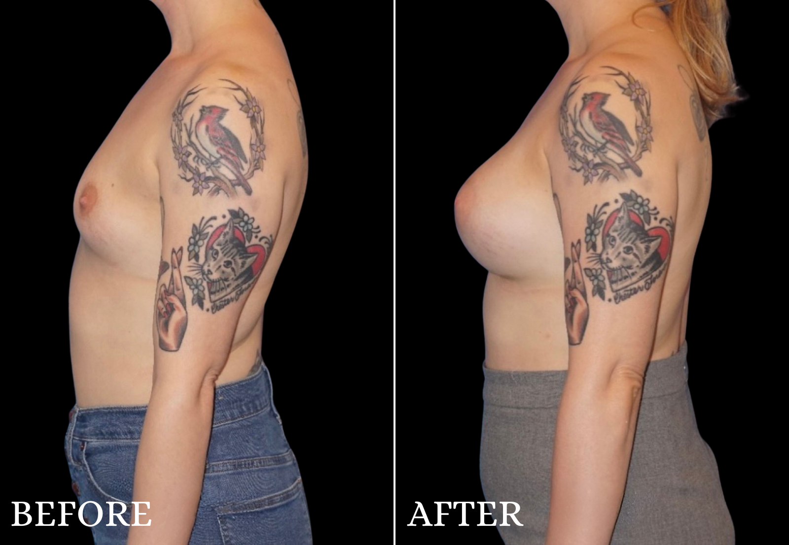 Breast Augmentation Before & After Gallery - Patient 109562 - Image 5