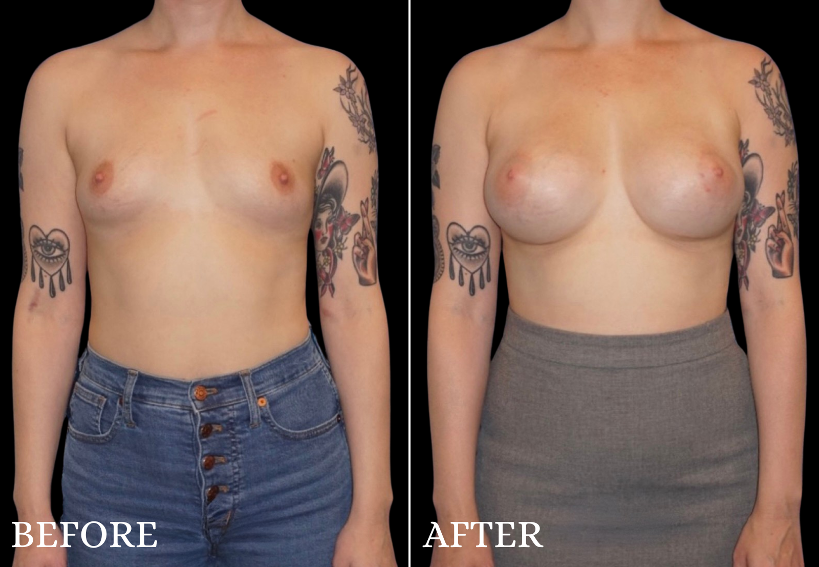 Breast Augmentation Before & After Gallery - Patient 109562 - Image 1