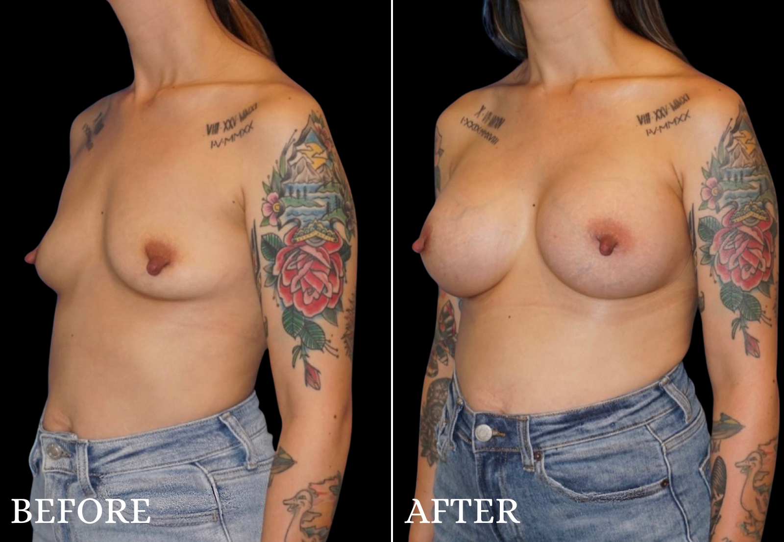 Breast Augmentation Before & After Gallery - Patient 376168 - Image 4