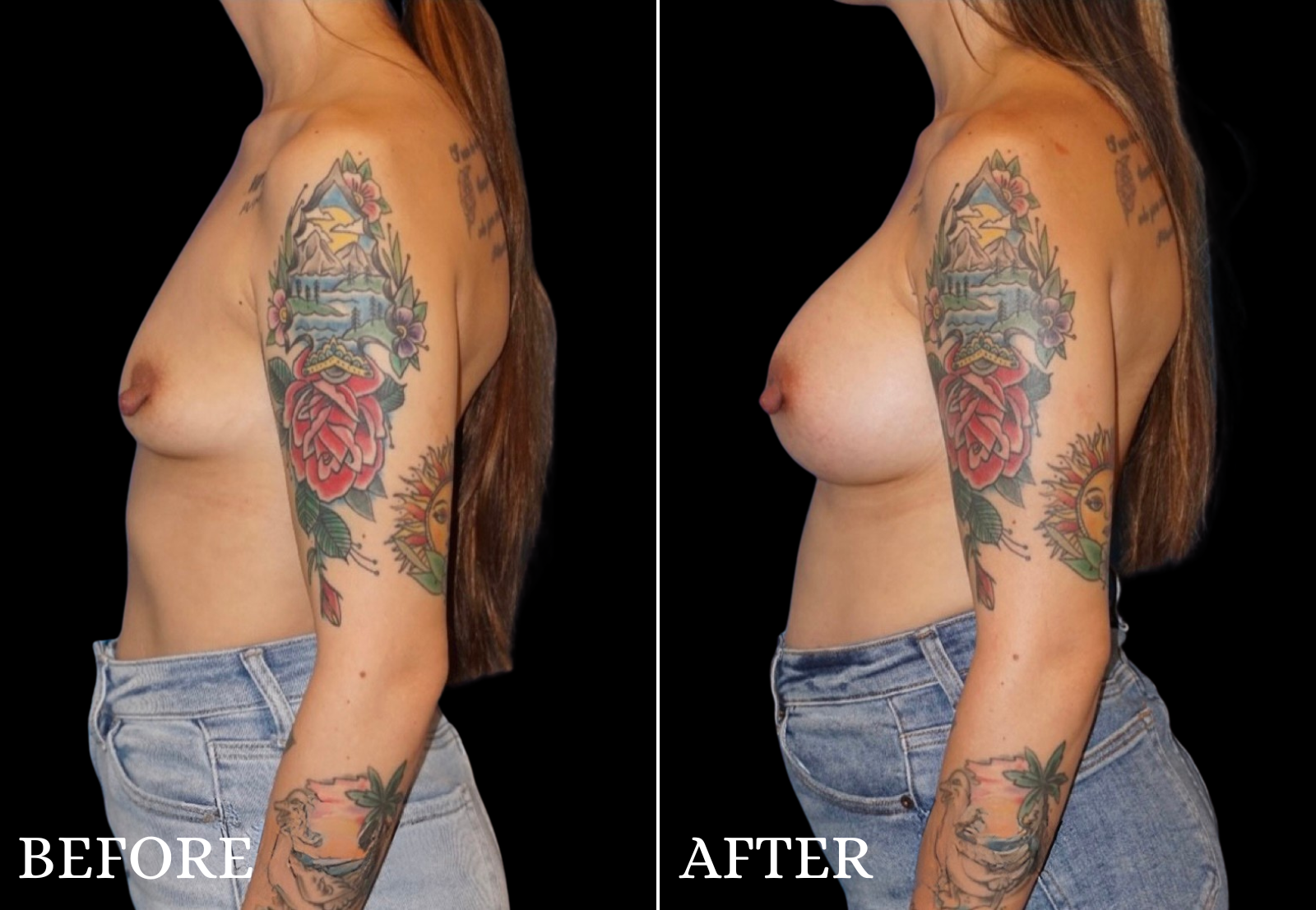 Breast Augmentation Before & After Gallery - Patient 376168 - Image 5