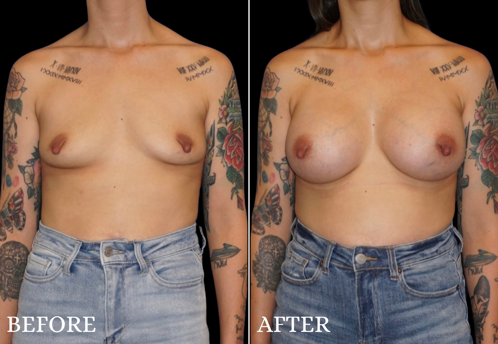 Breast Augmentation Before & After Gallery - Patient 376168 - Image 1